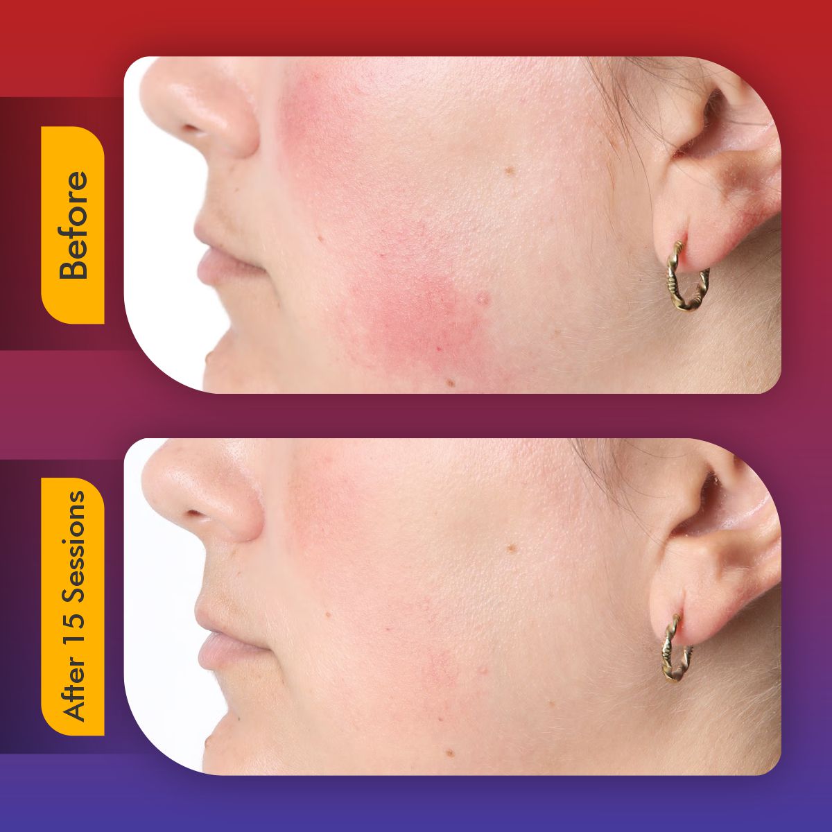 Revita Light Pro | LED Face Mask