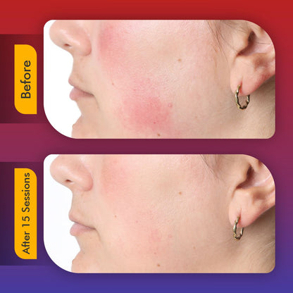 Revita Light Pro | LED Face Mask